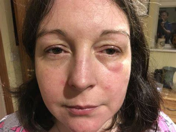 Behind Martin's Swollen Face: Shocking Revelation!